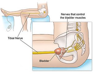 Lower urinary tract disorders